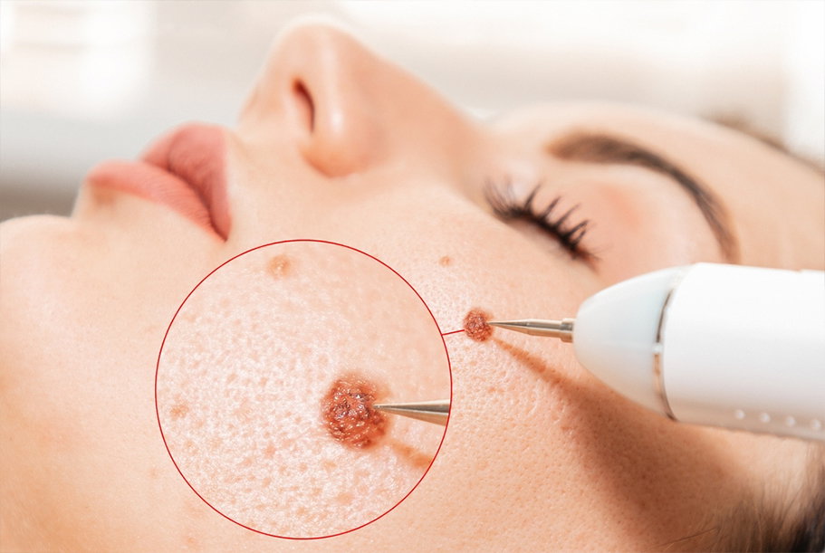 Warts / Skin Tag Removal