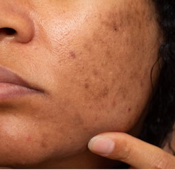 Hyperpigmentation & Dark Marks