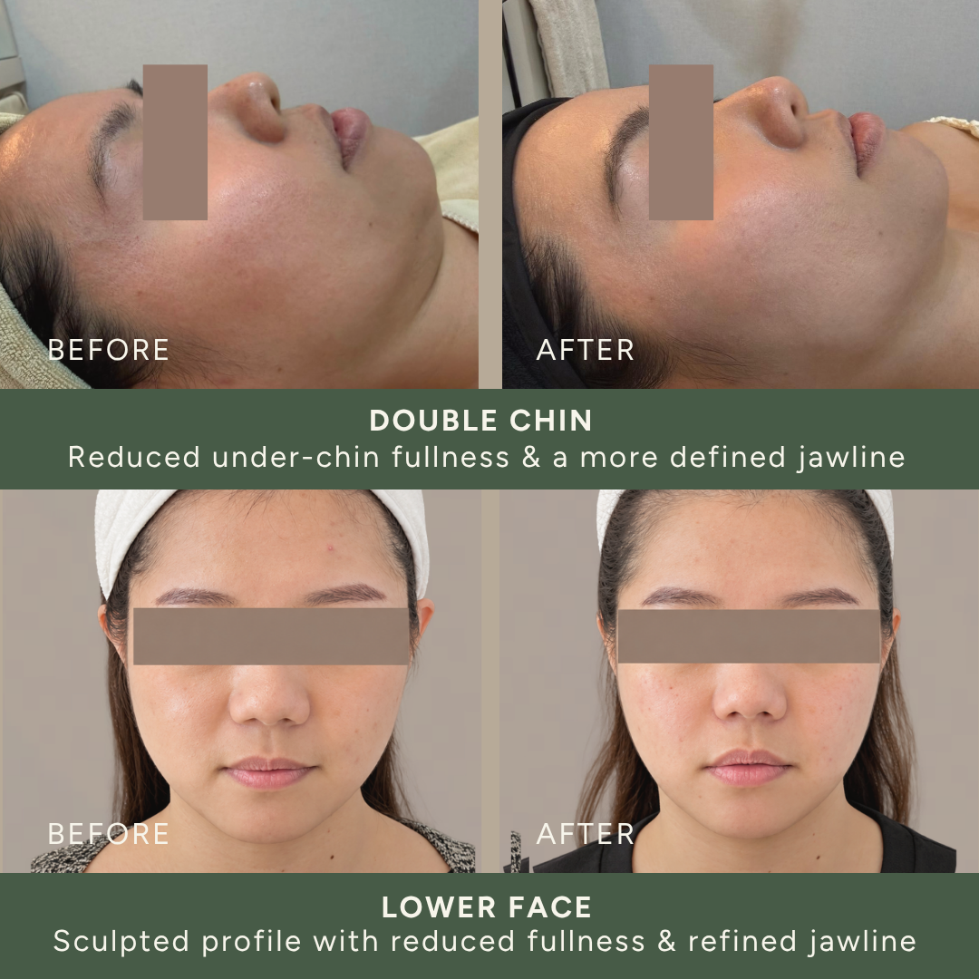 Onda Pro V-Face _1