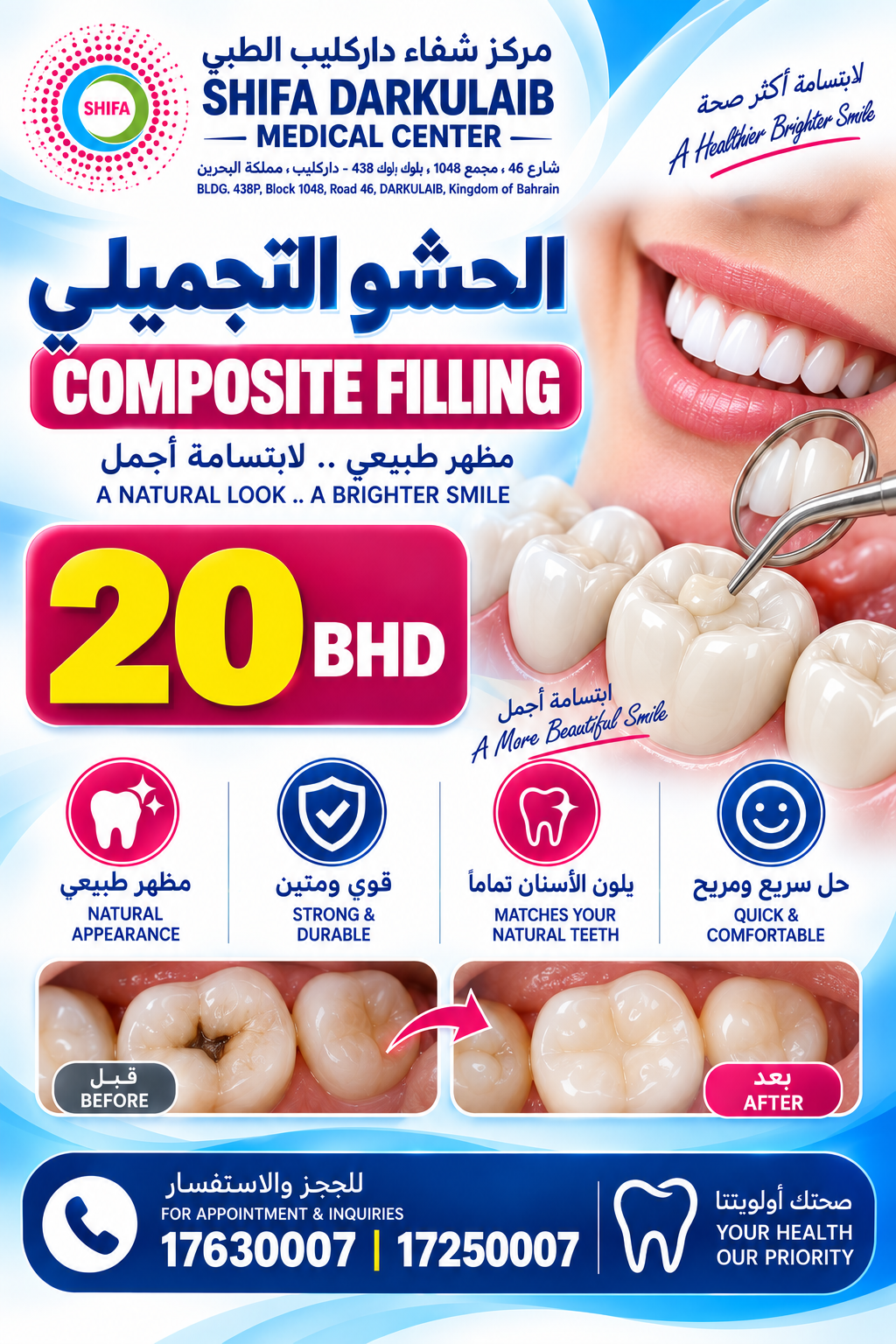 Composite Filling | الحشو التجميلي