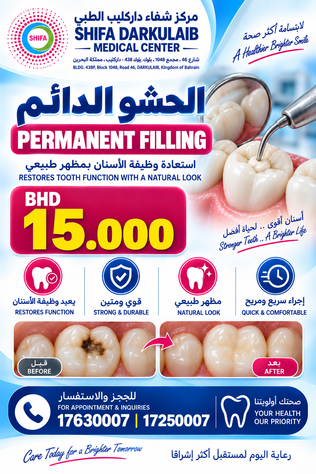 Permanent Filling | الحشو الدائم