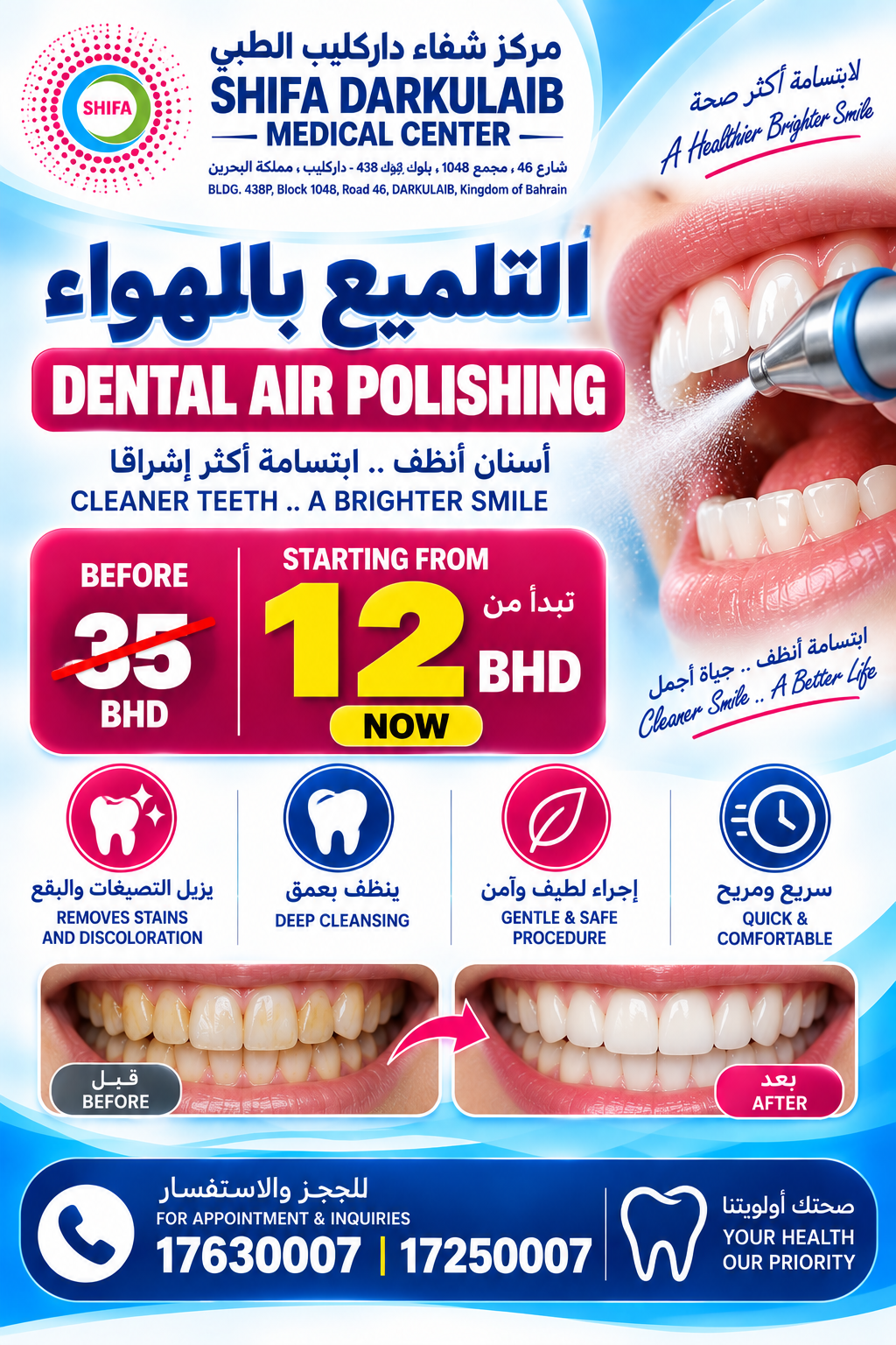 Dental Air Polishing | تلميع الأسنان بالهواء